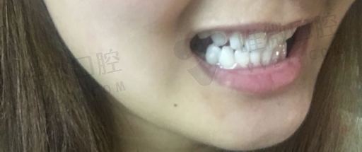水晶锆牙冠好不好（全锆牙冠价格）(图1)